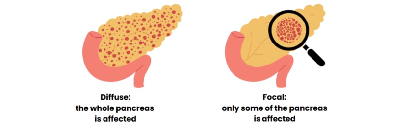 the pancreas