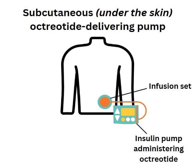 Under skin pump